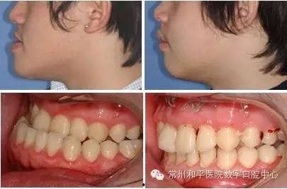 成人反颚如何矫正图片视频,图片与视频解析