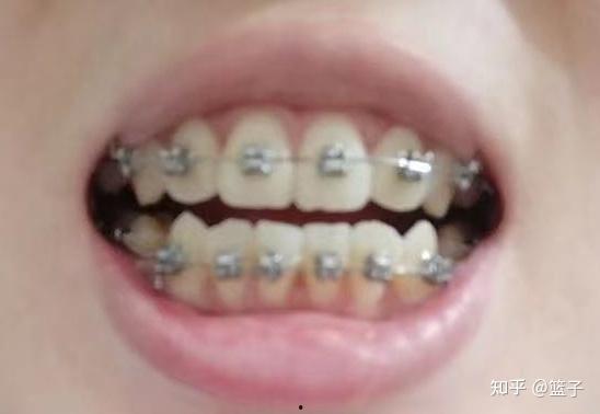 成人正畸外翻磨牙视频,视频详解